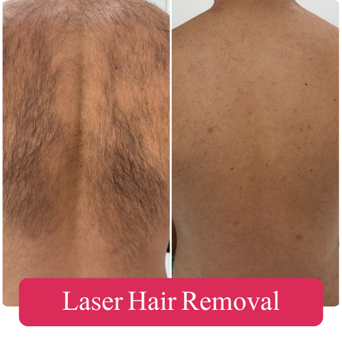 Laser Hair Removal